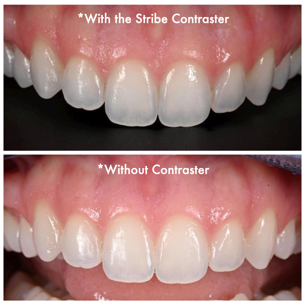 Upper anterior teeth photographed with and without the Stribe Contrastor