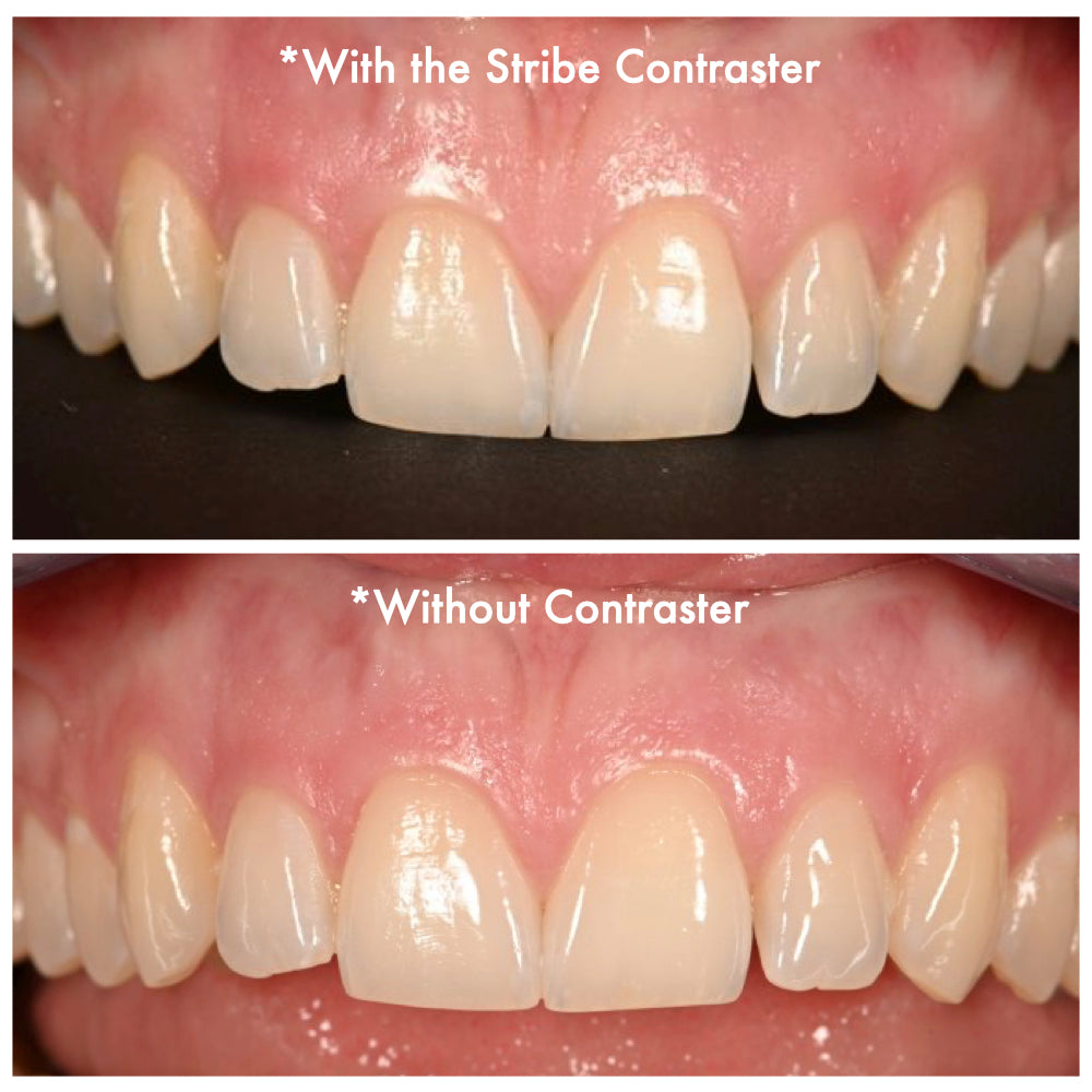 Comparison of anterior dental photos with and without a black contrastor