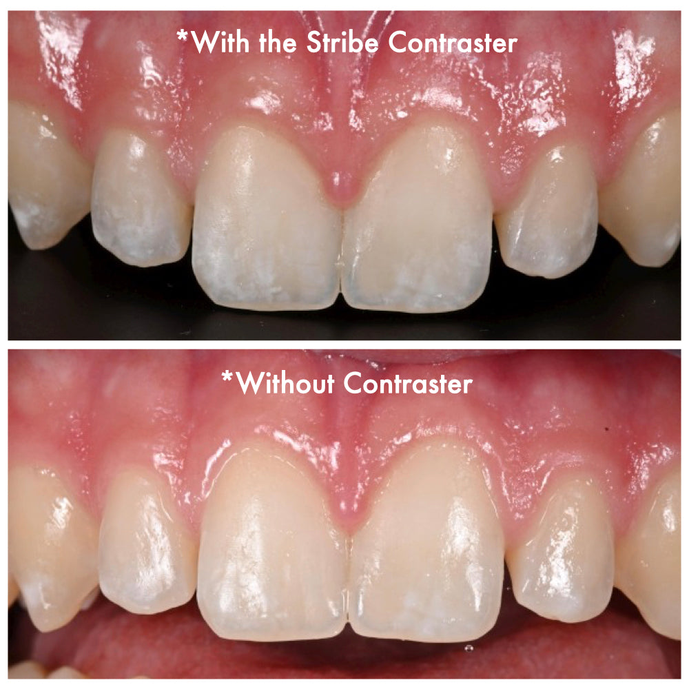Central incisor detail photographed with and without the Stribe Contrastor