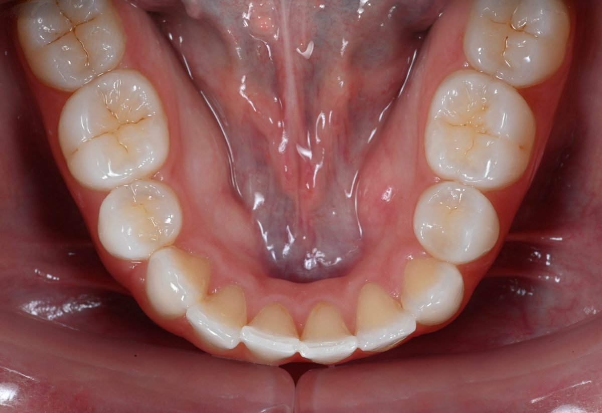 Lower occlusal dental photo taken with the Stribe occlusal mirror