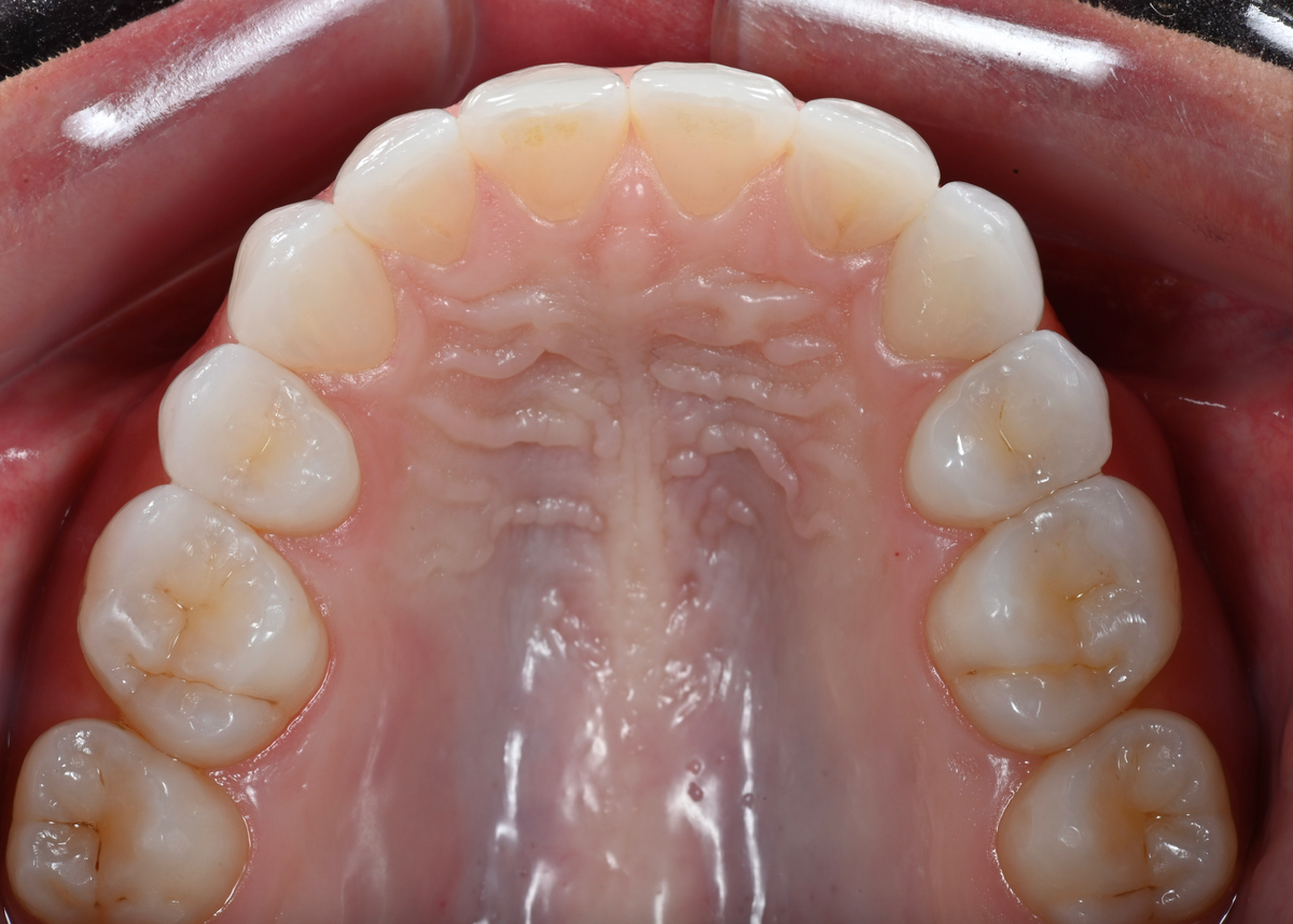 Upper occlusal dental photo taken with the Stribe occlusal mirror