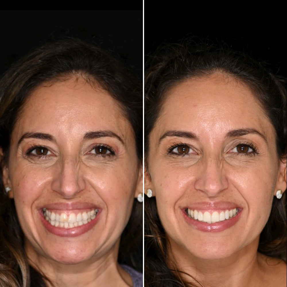 Before and after smile portrait with a clean black background for dental photography
