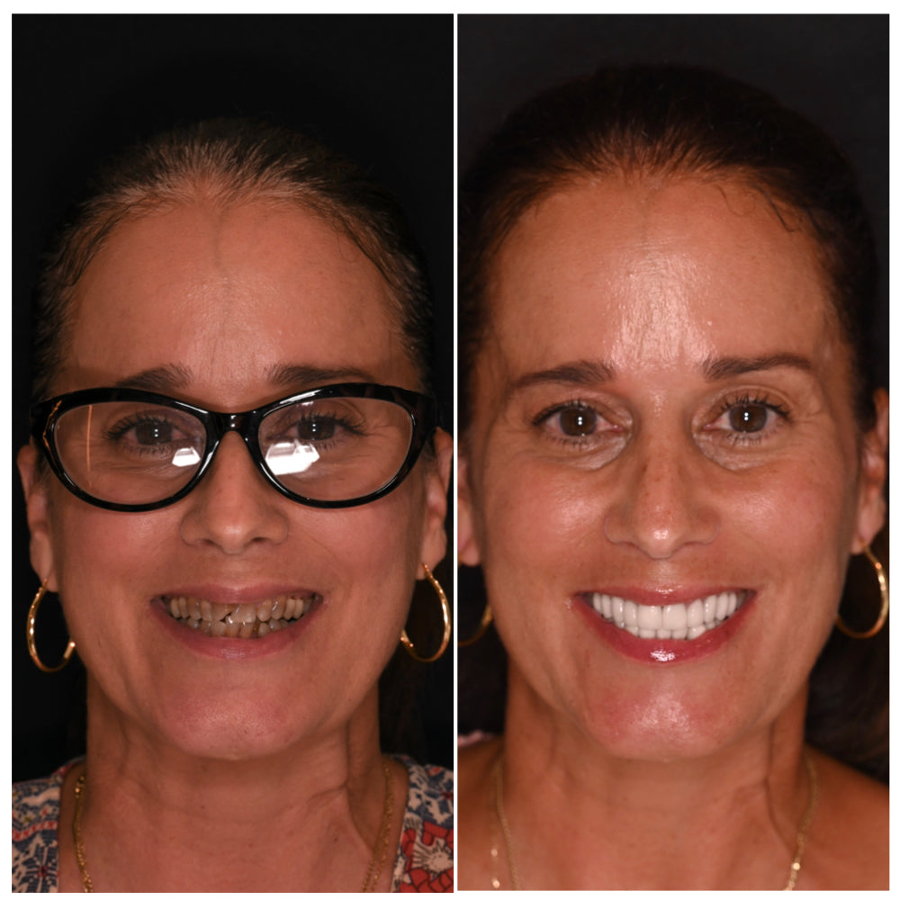 Before and after cosmetic dentistry portrait taken with the Stribe Portrait Background