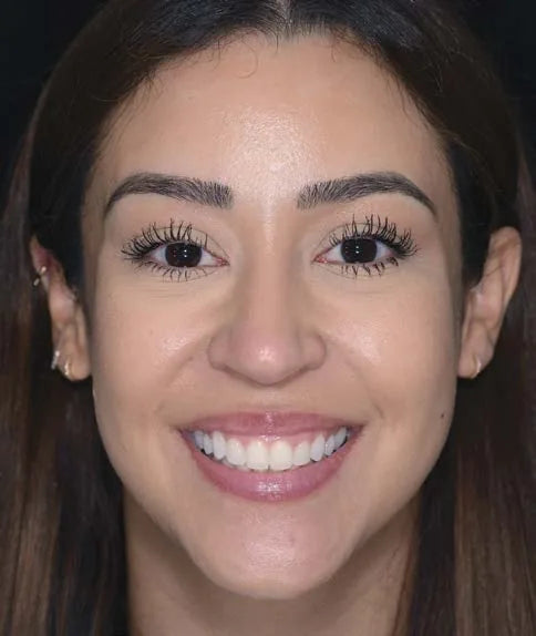 Full face smile photo, natural, frontal