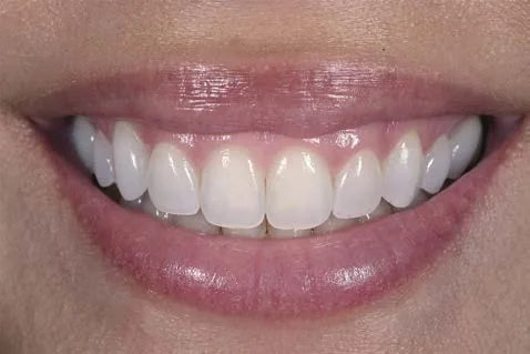 Natural full smile, frontal