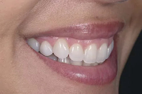 Natural smile, right lateral