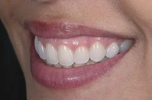 Natural smile, left lateral