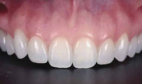 Maxillary anterior close-up, frontal