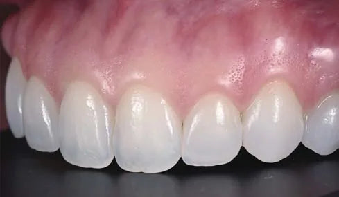 Maxillary anterior close-up, right