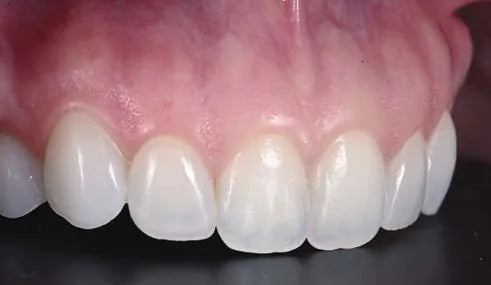 Maxillary anterior close-up, left