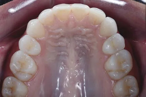 Maxillary occlusal photo taken with an occlusal mirror