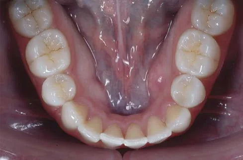 Mandibular occlusal photo taken with an occlusal mirror