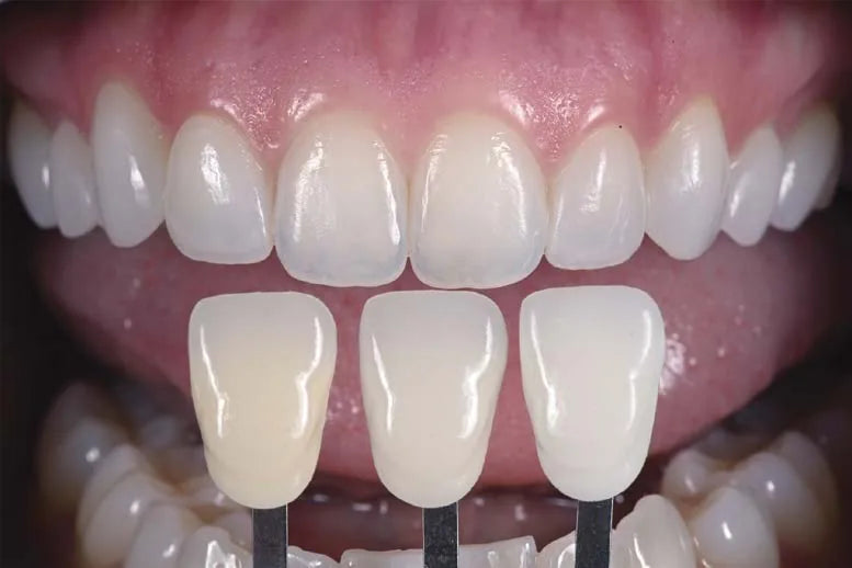 Retracted photo with three shade tabs held in the same plane as the upper teeth