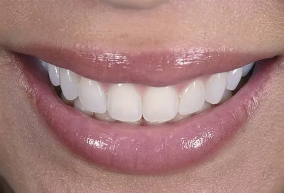 Dental photography mistake: frontal smile shot with the camera too high