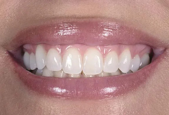 Dental photography mistake: frontal smile shot with the camera too low