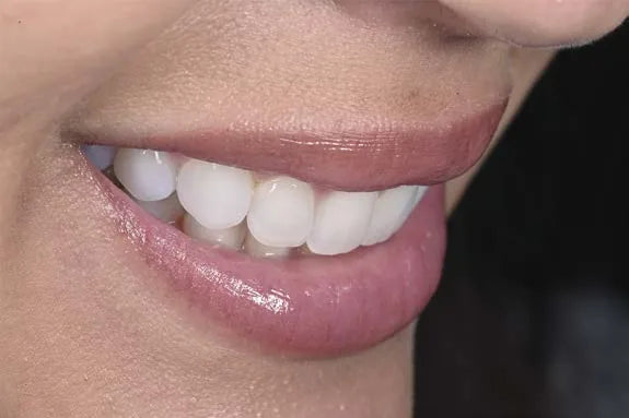 Dental photography mistake: lateral smile shot with the camera too high