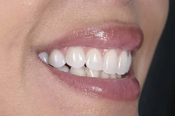 Dental photography mistake: lateral smile shot with the camera too low