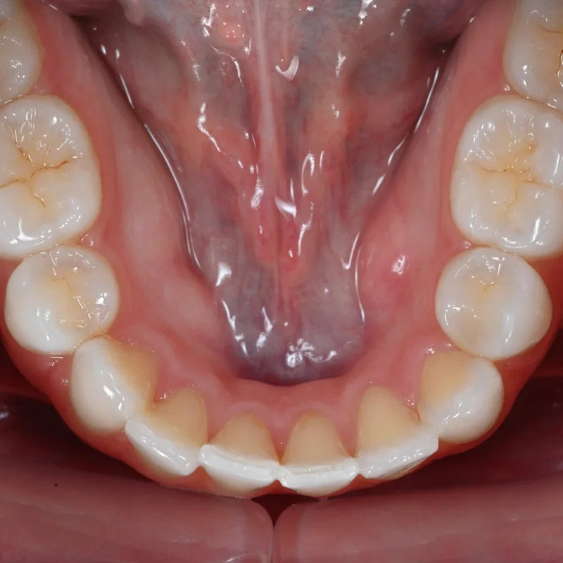 Lower occlusal dental photo taken with the Stribe occlusal mirror