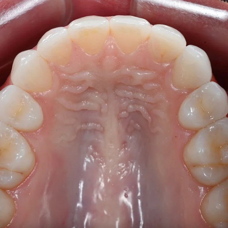 Upper occlusal dental photo taken with the Stribe occlusal mirror