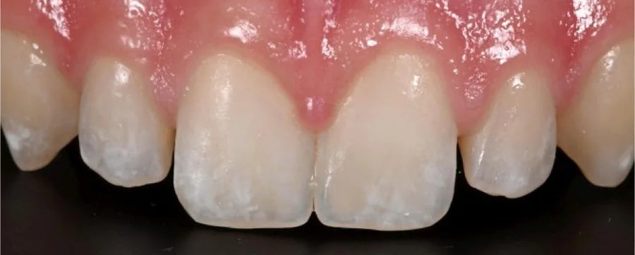 Upper central incisors photographed with the Stribe Contrastor on a black background