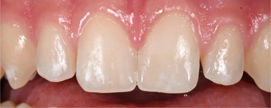 The same upper central incisors photographed without a contrastor